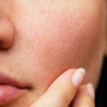 Как сузить поры? Лучшие способы избавиться от расширенных пор