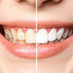 Как отбелить зубы в домашних условиях?