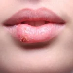 Все, что тебе нужно знать о герпесе