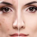 Как убрать возрастные пигментные пятна: лучшие средства и способы